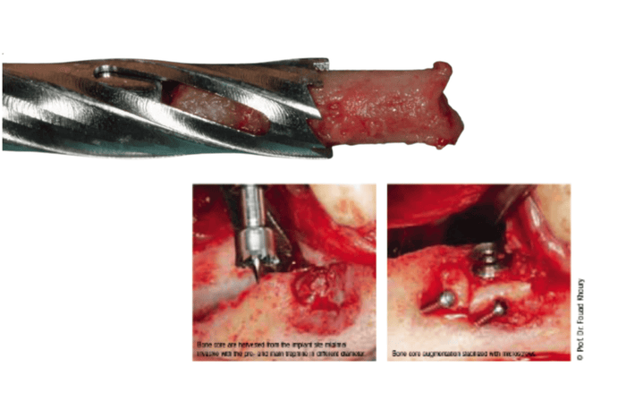 Dr. Fouad Khoury Trepan ejection kit (Karotte Teknik)