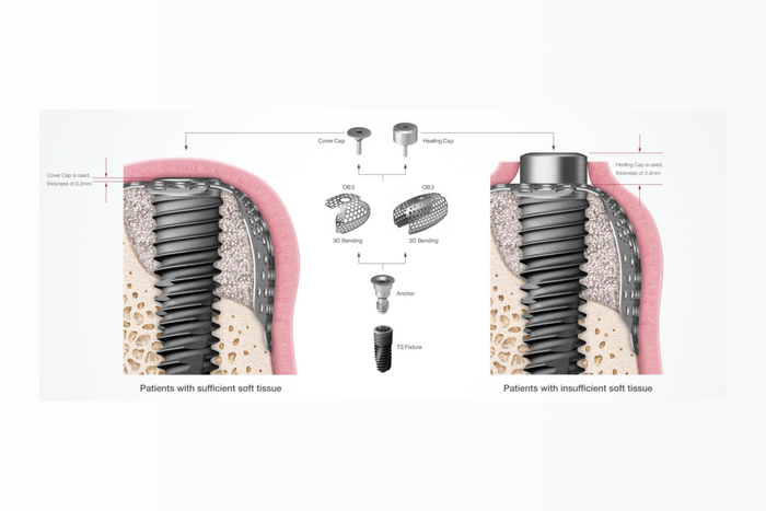 OssBuilder komponent, Cover Cap