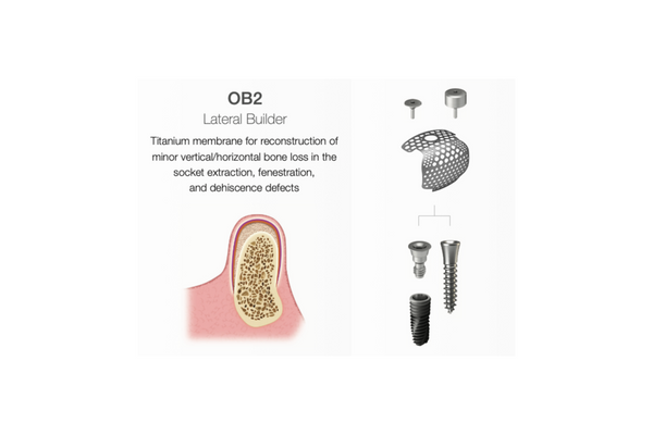 OssBuilder OB2, lateral Builder - 1 Wall