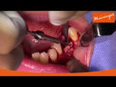 Dr. Fouad Khoury Trepan ejection kit (Karotte Teknik)